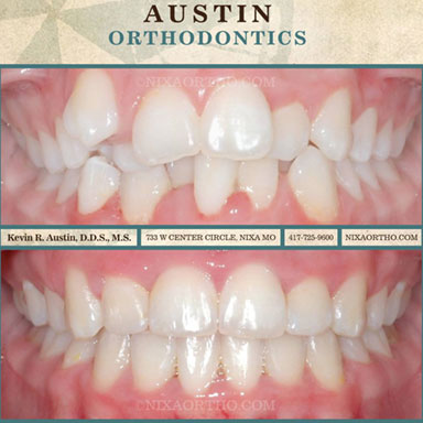 Dentalcrowding-with4bicuspidextrations-resized