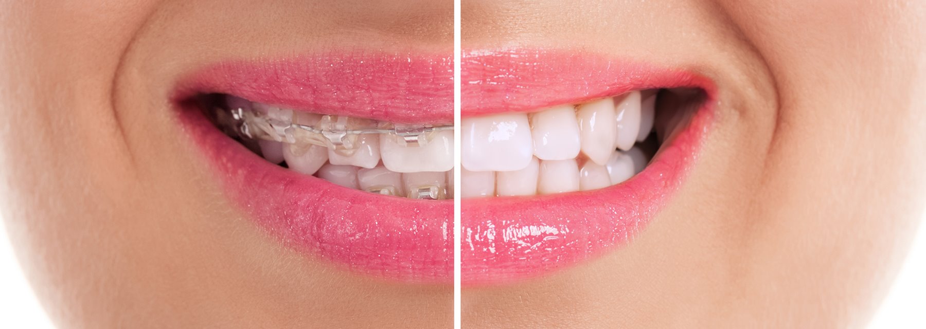 Before After Photos of Orthodontics Clinic