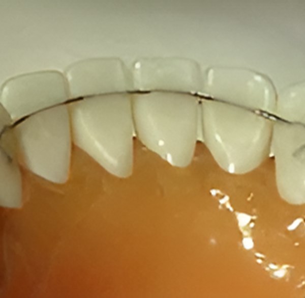 Retainers After Braces | Orthodontic Retention | Nixa